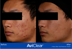 Acne Before AviClear and After AviClear