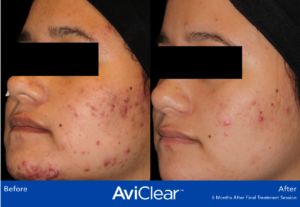 Acne Before AviClear and After AviClear